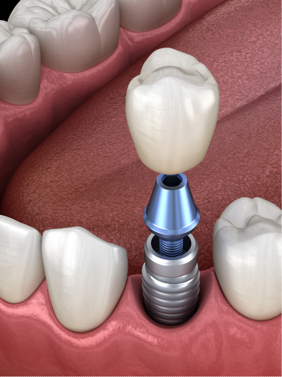 Read more about the article Implants at E Dental
