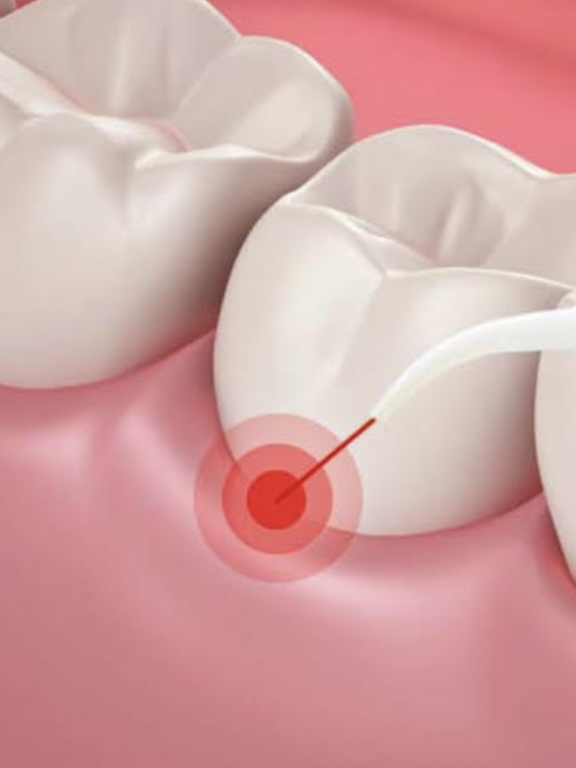 Read more about the article Periodontal therapy at E Dental