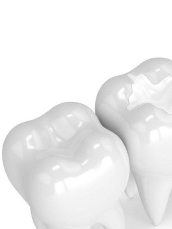 Read more about the article Tooth Fillings at E Dental