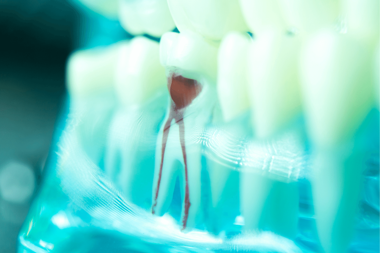 Read more about the article Root Canals at E Dental